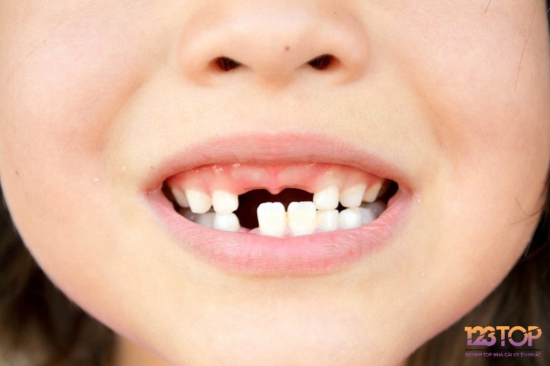 Mỗi tình huống gãy răng ẩn chứa điềm báo khác nhau về tài lộc, sức khỏe và mối quan hệ xung quanh