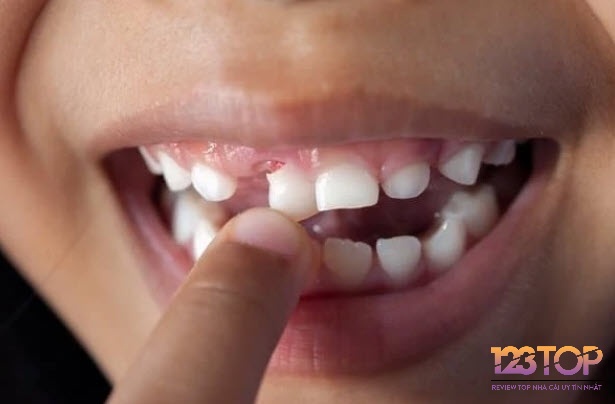 Giấc mơ gãy răng của người khác hay răng giả phản chiếu mối lo ngại về sự thật và các mối quan hệ xung quanh